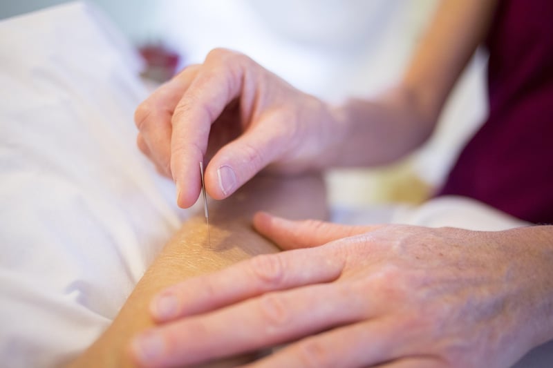Acupuncture therapy